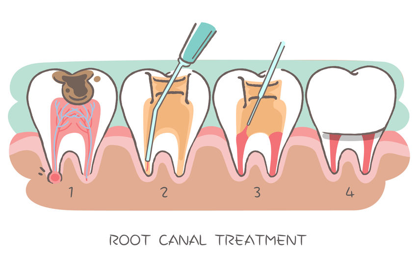 about root canal