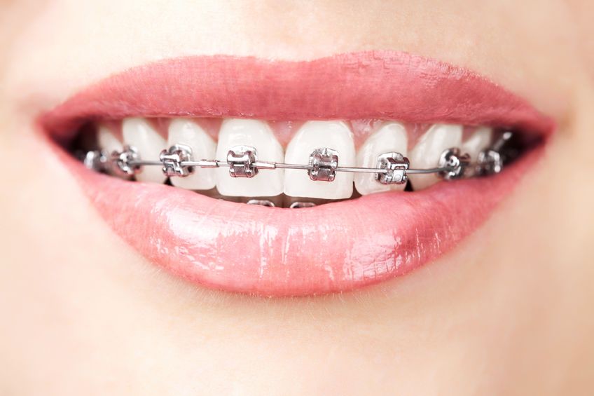 Orthodontic Treatment As An Adult