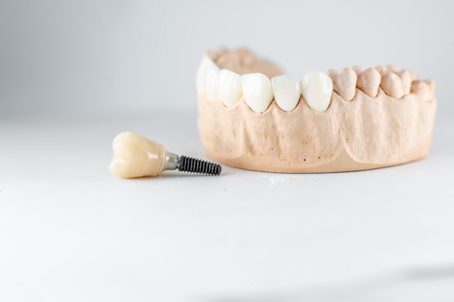 dental bone implant
