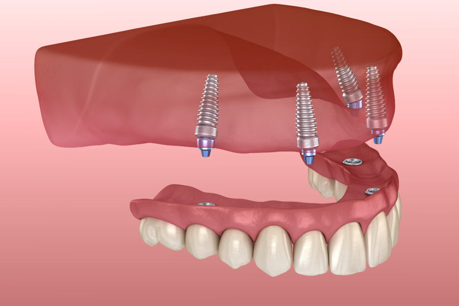 all on 4 dental implants cost