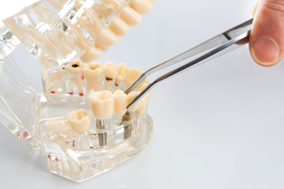 Dental Implants Cost