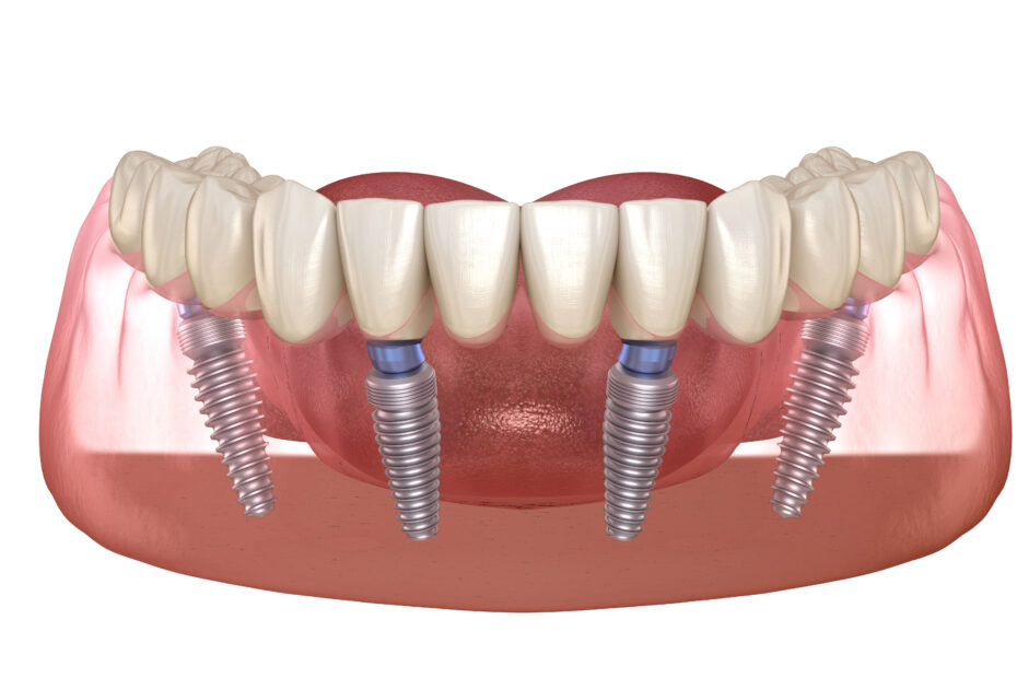 All on 4 Implants Cost Australia