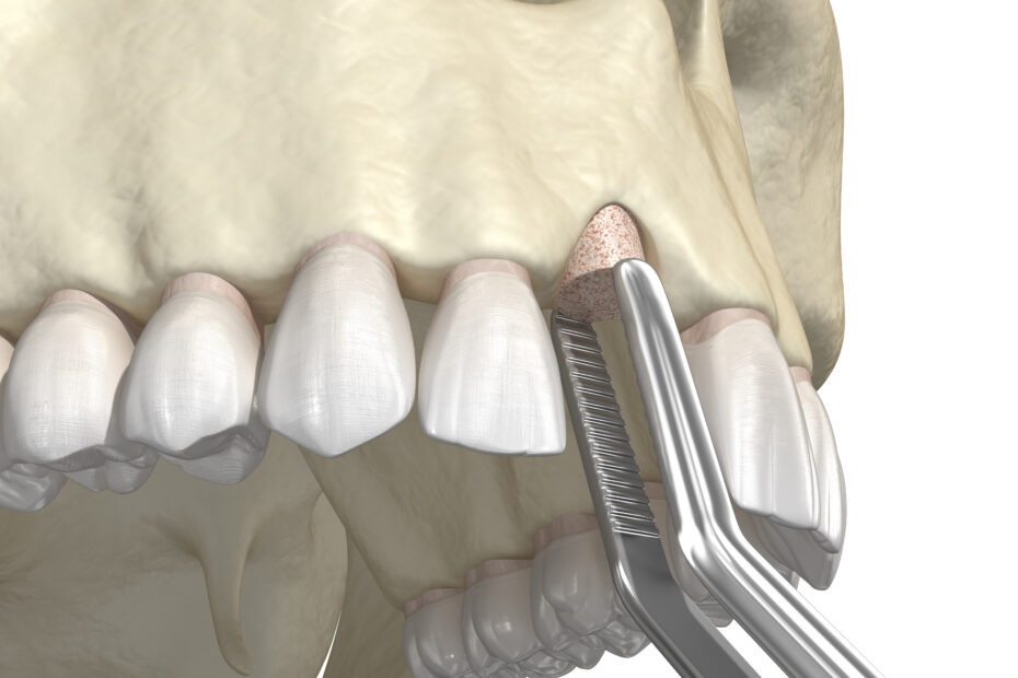 Dental Bone Graft Cost
