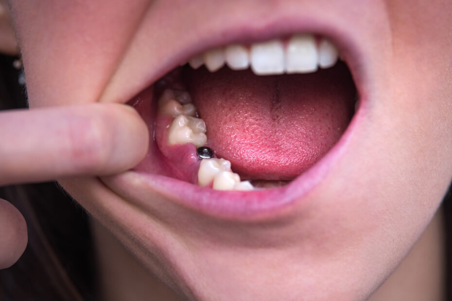 Single Tooth Implant